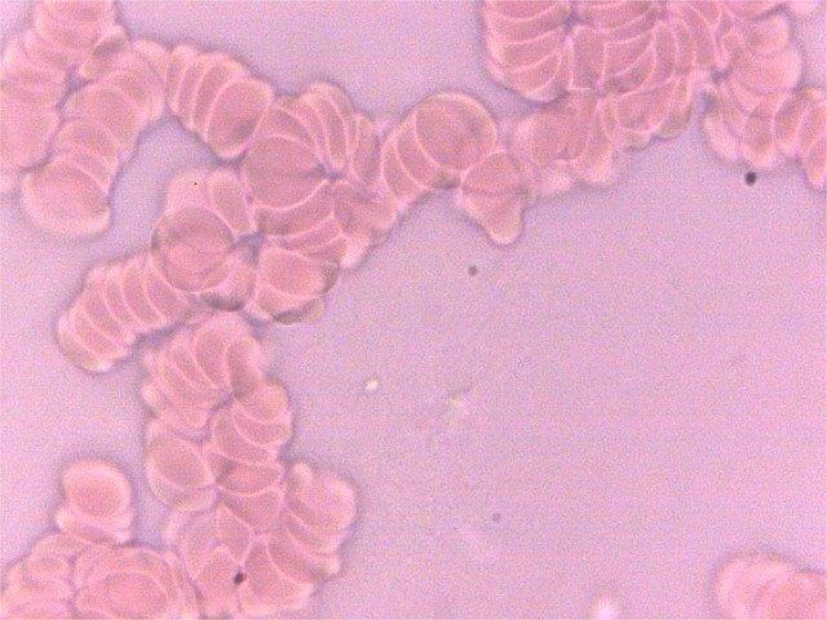 Before E+V for treatment of advanced prostate cancer